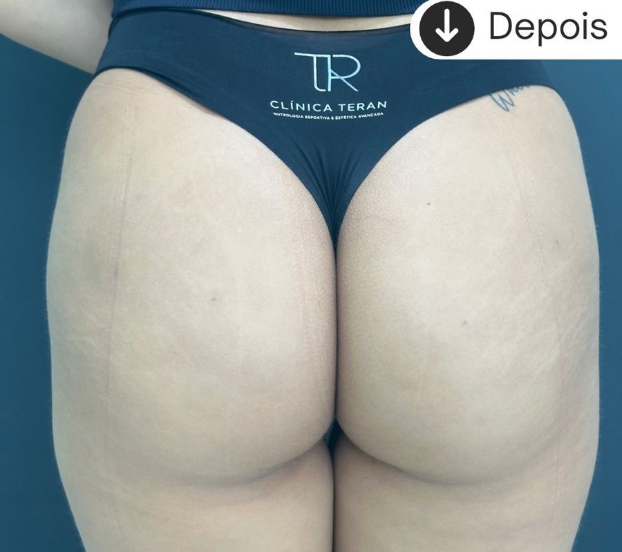 Depois: Remodelação glútea com bioestimulador