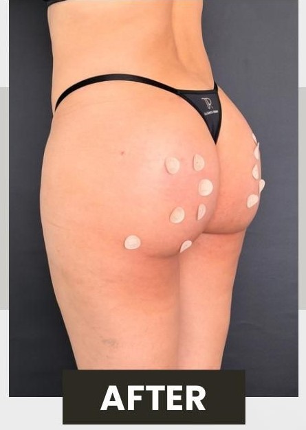 Depois: Resultado remodelação corporal